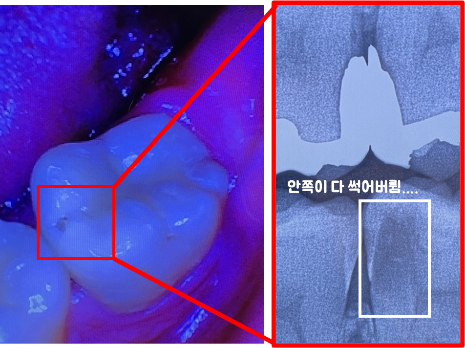 치과 검진에서 확인한 좋지 않은 치아 상태